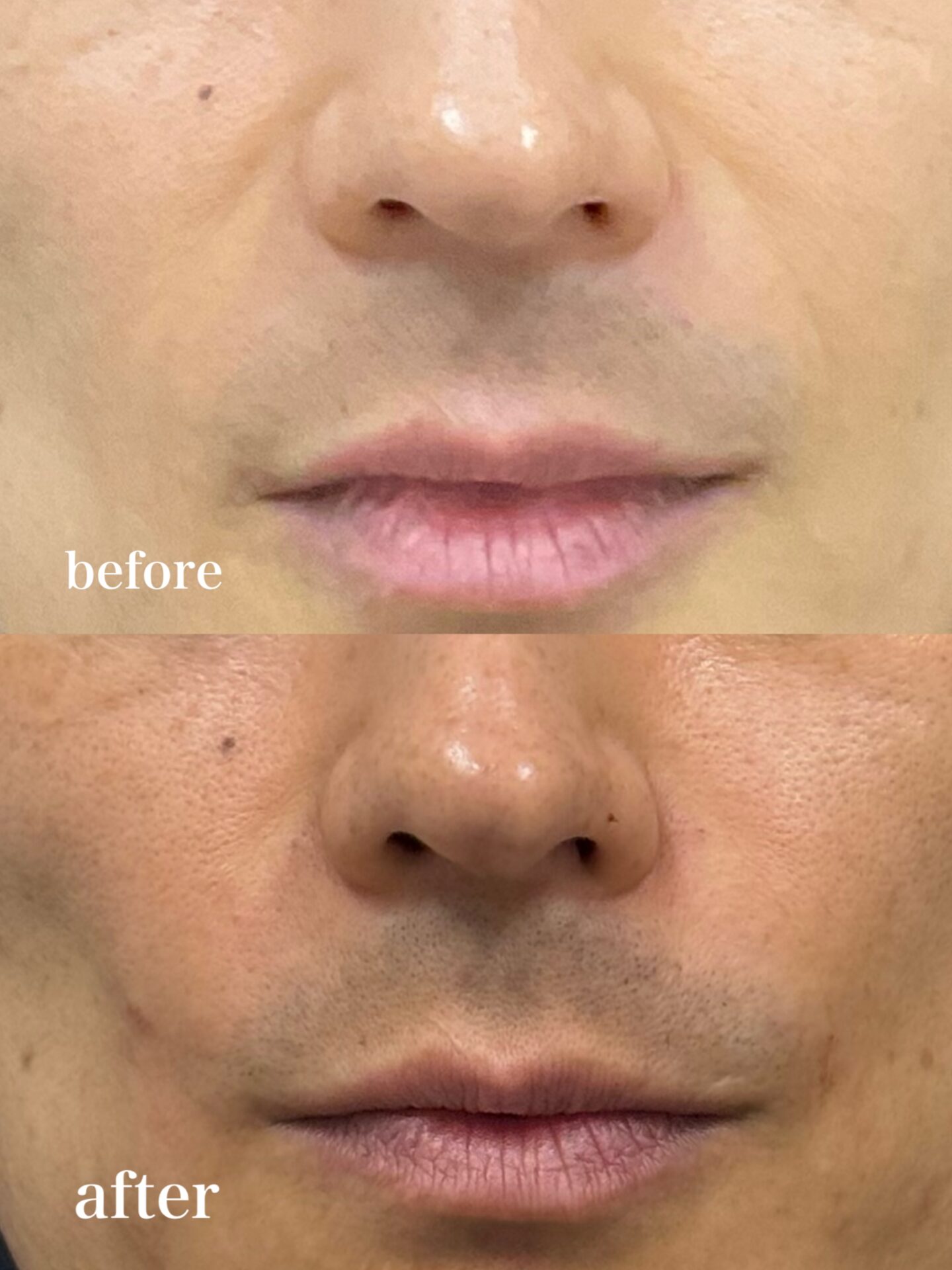 Hyaluronic Acid Injection Techniques to Avoid an Unnatural Finish