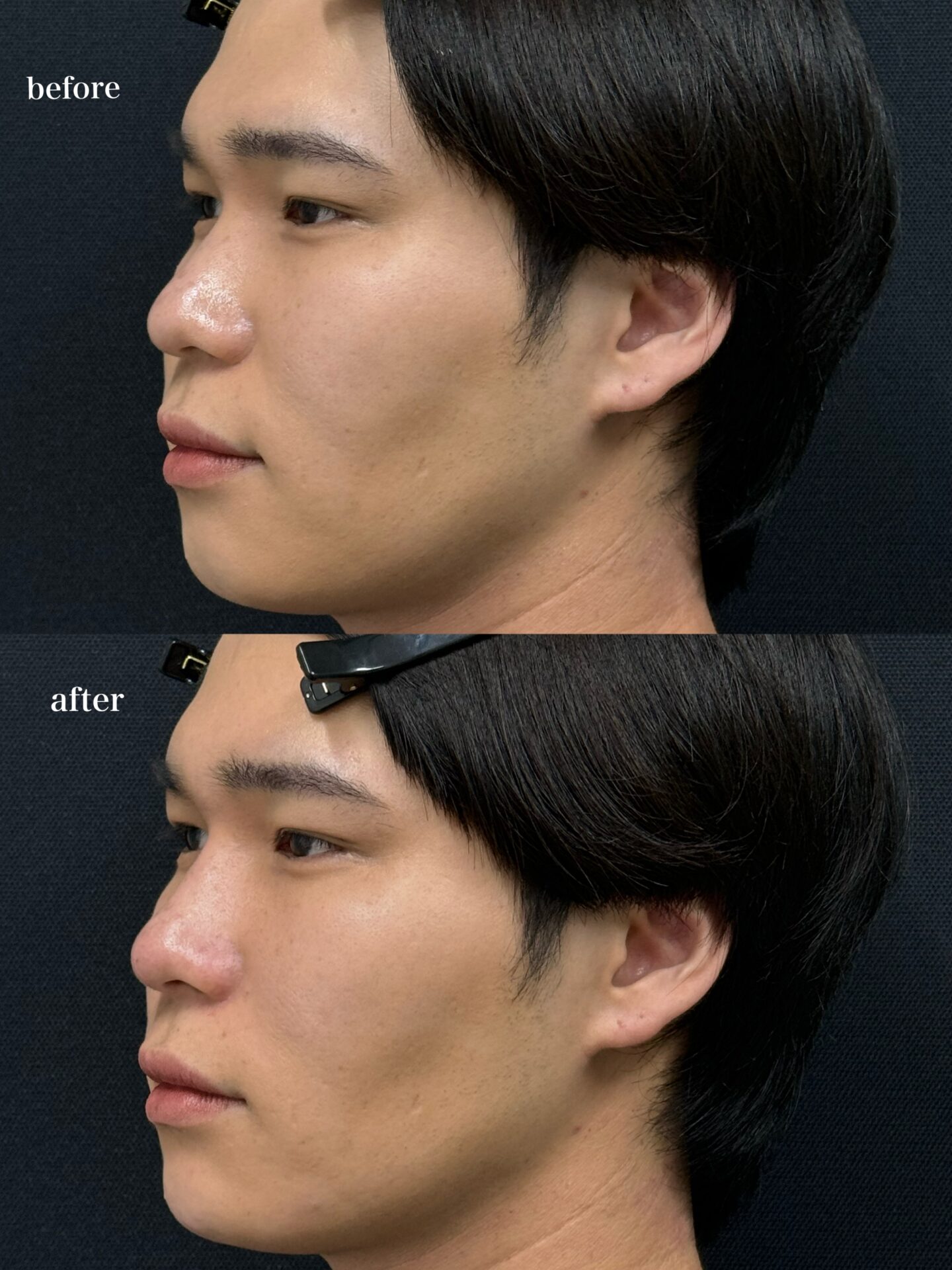 Considering the Effects and Risks of Hyaluronic Acid Injections for Beautifying the Nose Tip