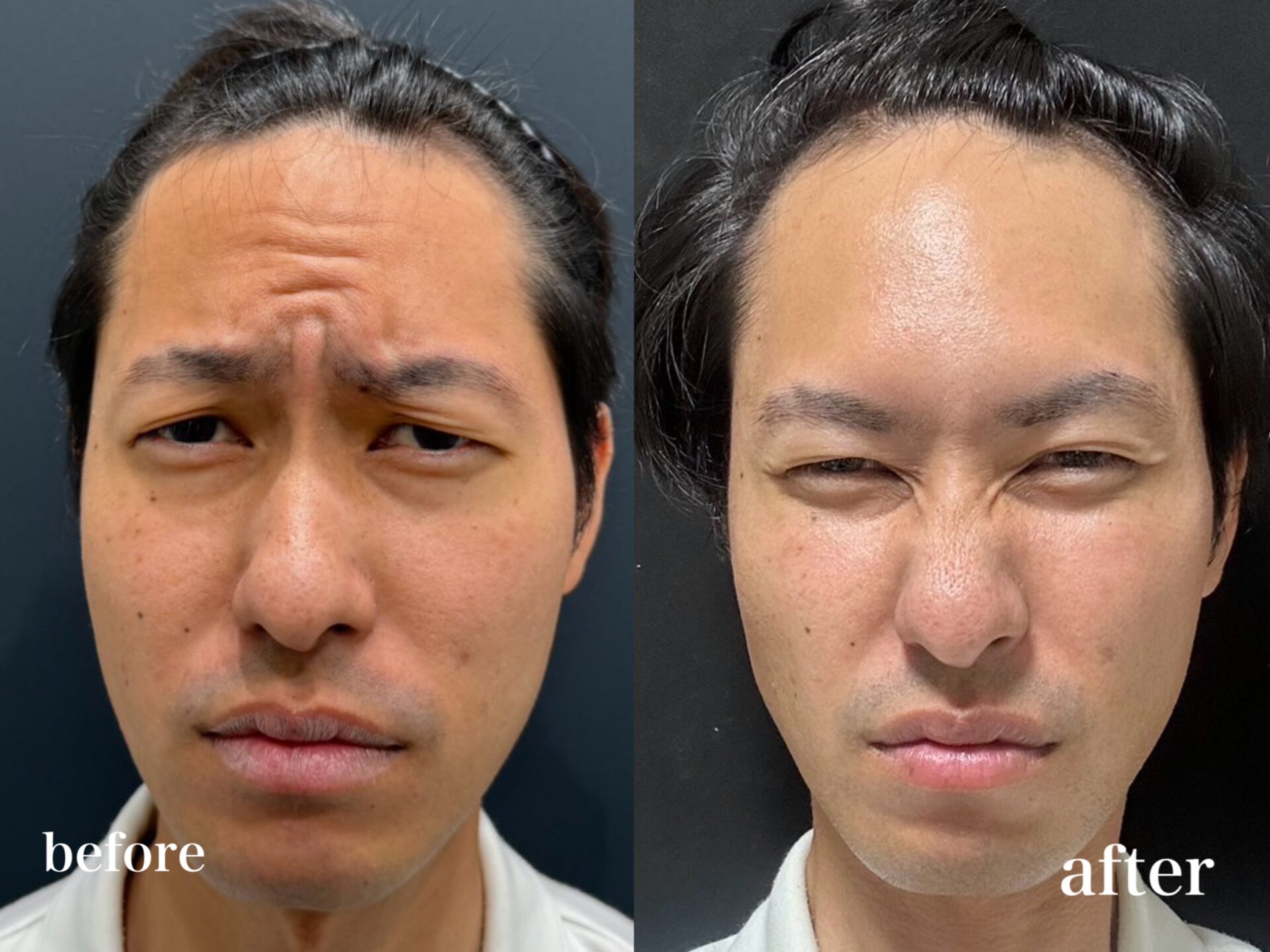 How to Improve Frown Lines with Botox