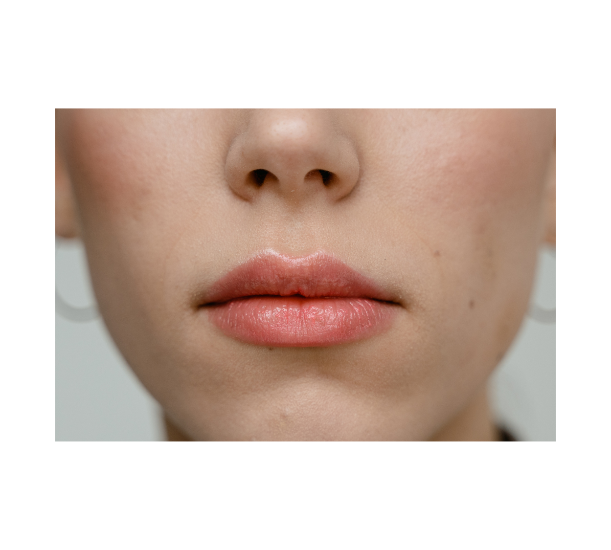 Everything You Need to Know About Upper Lip Shortening Botox for Confidence