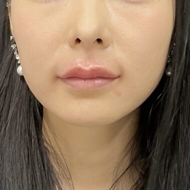After