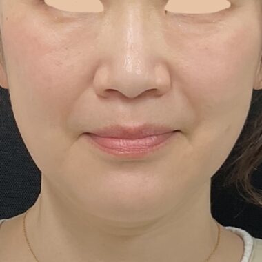 After