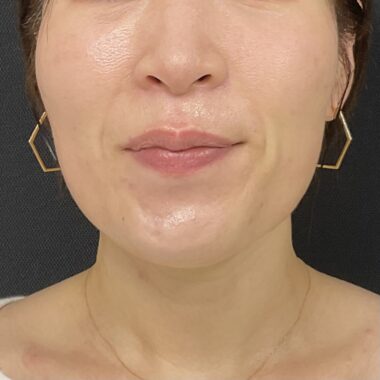 After