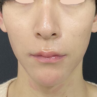 After