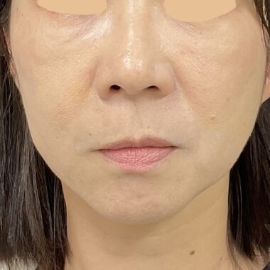After