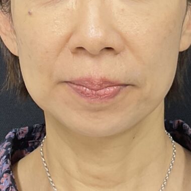 After