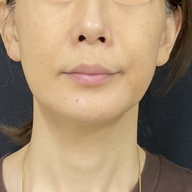 After