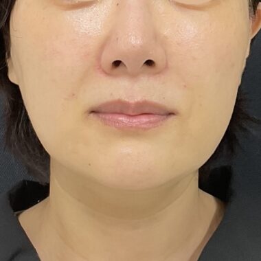 After