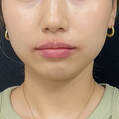 After