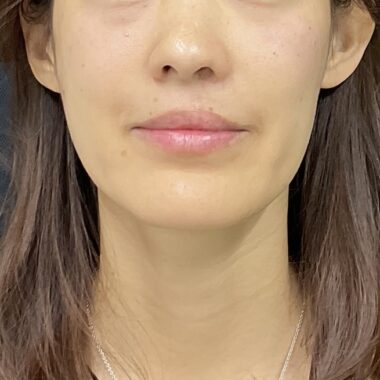 After