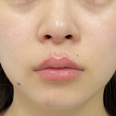 After