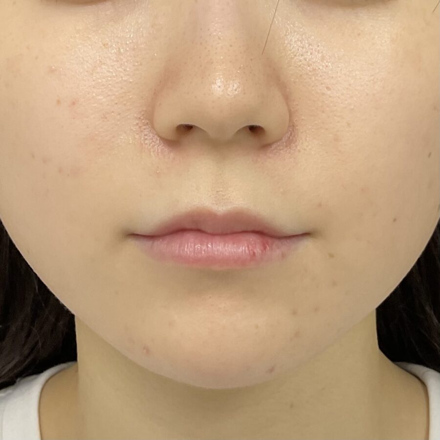 Before